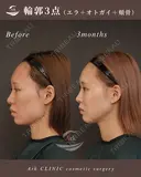 輪郭３点（頬骨＋エラ＋オトガイ） before画像 サムネイル用