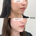 顔の脂肪吸引＋切らない顎形成 3D Eライン＋小顔美肌再生（リフトアップ） before画像 サムネイル用