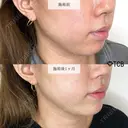 顔の脂肪吸引＋切らない顎形成 3D Eライン＋小顔美肌再生（リフトアップ）＋顎（あご）のヒアルロン酸注射 before画像 サムネイル用