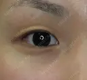 【20代女性・腫れにくい二重術】マイクロメソッド＋α（直後） before画像 サムネイル用