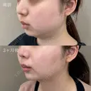小顔美肌再生（リフトアップ）＋顔の脂肪吸引＋切らない顎形成 3D Eライン+バッカルファット除去＋メーラーファット除去＋ジョールファット除去 after画像 サムネイル用