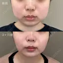 小顔美肌再生（リフトアップ）＋顔の脂肪吸引＋切らない顎形成 3D Eライン+バッカルファット除去＋メーラーファット除去＋ジョールファット除去 after画像 サムネイル用
