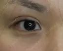 【20代女性・腫れにくい二重術】マイクロメソッド＋α（直後） after画像 サムネイル用