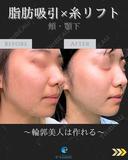 顔の脂肪吸引＋糸リフト before画像 サムネイル用