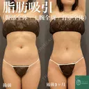 コンプリート脂肪吸引（上下腹部・ウエスト・腰）シリンジ法/形成外科専門医✨ after画像 サムネイル用