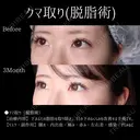 切らない目の下のクマ取り(脱脂術) 90日後 サムネイル用