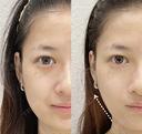 ハイフシャワー600ショット after画像 サムネイル用