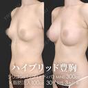 ハイブリッド豊胸（シリコンバッグ豊胸＋脂肪幹細胞注入豊胸） before画像 サムネイル用