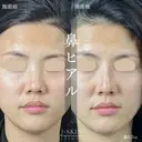 アラガン社ジュビダームビスタ使用✨鼻ヒアル0.7㏄💉 after画像 サムネイル用