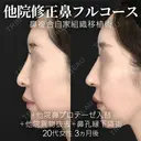 他院異物除去＋他院鼻プロテーゼ入替＋鼻フルコース（鼻複合自家組織移植術）＋鼻孔縁下降術 before画像 サムネイル用