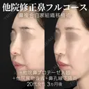 他院異物除去＋他院鼻プロテーゼ入替＋鼻フルコース（鼻複合自家組織移植術）＋鼻孔縁下降術 90日後 サムネイル用