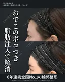 額・こめかみの脂肪注入 (コンデンスリッチ) 30日後 サムネイル用