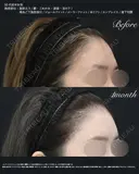 額・こめかみの脂肪注入 (コンデンスリッチ) before画像 サムネイル用