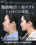 脂肪吸引(頬・あご下・ジョールファット・メーラーファット) / バッカルファット除去 / 糸リフト / 目の下の切らないクマ・たるみ取り / 脂肪注入 (額・あご・目の下〜ゴルゴ線) 30日後 サムネイル用