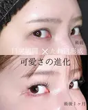 目尻切開＋下眼瞼拡大・下制限（タレ目形成） 皮膚＋結膜 after画像 サムネイル用