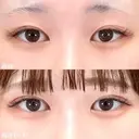 二重埋没法＋涙袋形成（ヒアルロン酸注射） 30日後 サムネイル用