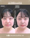 エラボトックス after画像 サムネイル用