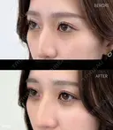 目の下のクマ取り・目の下のたるみ（ふくらみ）取り before画像 サムネイル用