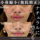 小鼻縮小(他院修正) before画像 サムネイル用