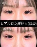 ヒアルロン酸注入（涙袋） before画像 サムネイル用