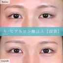 Wing式 涙袋ヒアルロン酸形成 7日後 サムネイル用