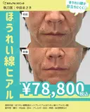 ほうれい線撃退セットプレミアム（ほうれい線 ヒアルロン酸 before画像 サムネイル用