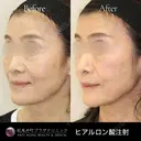 ヒアルロン酸注入（たるみ改善） before画像 サムネイル用
