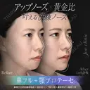 鼻フルコース（鼻複合自家組織移植術）＋筋膜移植＋超音波鼻骨骨削り術＋顎プロテーゼ挿入術 before画像 サムネイル用