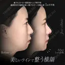 鼻フルコース（鼻複合自家組織移植術）＋筋膜移植＋超音波鼻骨骨削り術＋顎プロテーゼ挿入術 45日後 サムネイル用
