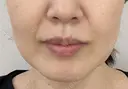 唇ヒアルロン酸 before画像 サムネイル用
