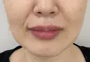 唇ヒアルロン酸 after画像 サムネイル用