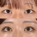 二重埋没法 after画像 サムネイル用