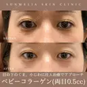 ベビーコラーゲン(0.5cc) before画像 サムネイル用