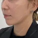顎ヒアルロン酸 after画像 サムネイル用