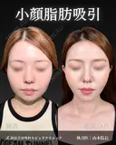 山本医師の🎀小顔整形🎀 before画像 サムネイル用