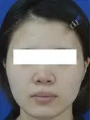 鼻尖縮小+鼻翼縮小 before画像 サムネイル用