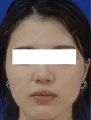 鼻尖縮小+鼻翼縮小 90日後 サムネイル用