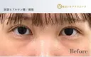 涙袋ヒアルロン酸 before画像 サムネイル用