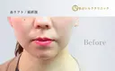 糸リフト before画像 サムネイル用