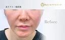 糸リフト before画像 サムネイル用