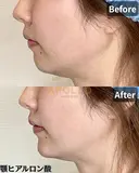 顎ヒアルロン酸注入 after画像 サムネイル用