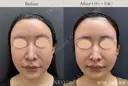 ジャルプロスーパーハイドロ before画像 サムネイル用