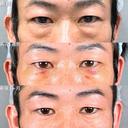 目の下の・クマ取り/脂肪注入(目の下・ゴルゴライン) before画像 サムネイル用