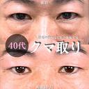 目の下の・クマ取り/脂肪注入(目の下・ゴルゴライン) 90日後 サムネイル用