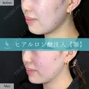 Wing式 顎ヒアルロン酸形成 after画像 サムネイル用