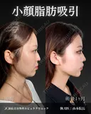 山本医師の🎀小顔整形🎀 before画像 サムネイル用