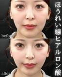 ほうれい線ヒアルロン酸 before画像 サムネイル用