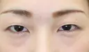 フォーエバーブリリアント埋没法 before画像 サムネイル用