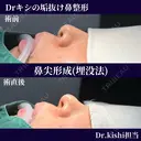 鼻尖形成(埋没法)✨ after画像 サムネイル用