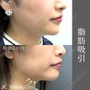 綺麗すぎるフェイスラインに🦋 ネビュラクリニックの脂肪吸引💫 after画像 サムネイル用